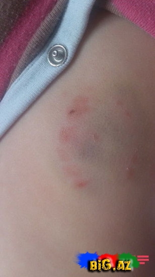 "Səadətin bədənində əzik və dişlək yerləri var"- FOTO