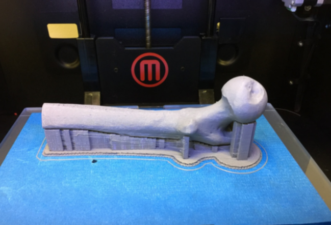 Xəstəyə 3d texnologiyası ilə yaradılan sümük toxuması köçürülüb- Dünyada İlk