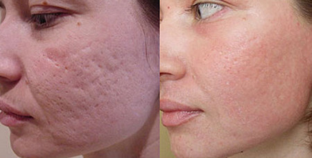 Üzdəki çapıqlardan necə qurtulmalı? - MÜALİCƏ ÜSULLARI