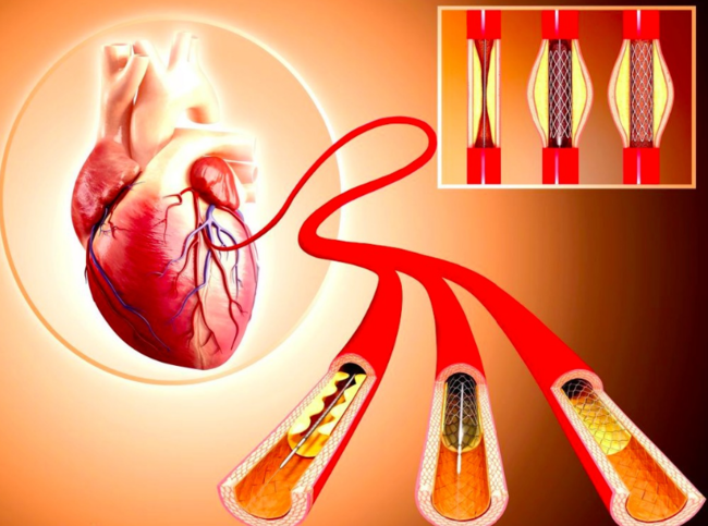 Ürək stenti haqqında bilmədikləriniz- Həkimlə MÜSAHİBƏ