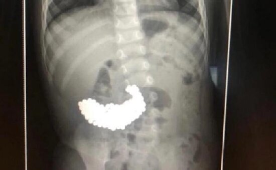 2 yaşlı uşağın mədəsindən çıxanlar hər kəsi ŞOK ETDİ - FOTO