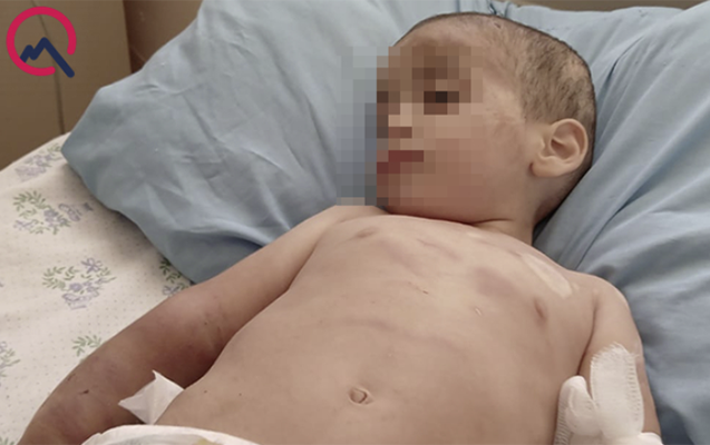 Döyülən azyaşlılardan birinin vəziyyəti ağırdır