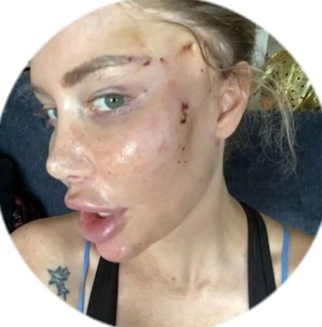 "Yatarkən tikişlərim açıldı, hər yerim qan oldu" - 14 dəfə əməliyyat olunan qız