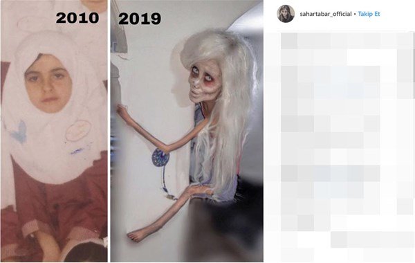 Coliye bənzəmək üçün onlarla əməliyyat etdirən fenomenin 10 il öncəki ŞOK HALI - FOTOLAR